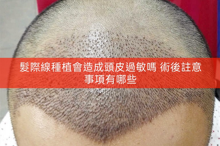 髮際線種植會造成頭皮過敏嗎 術後註意事項有哪些