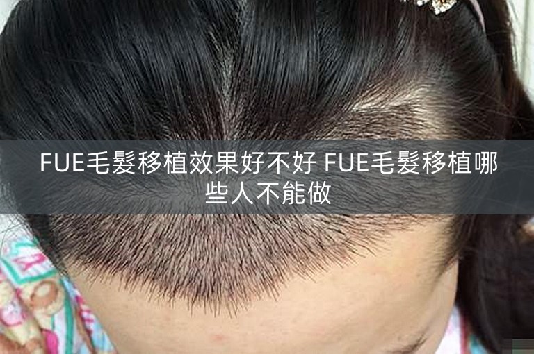 FUE毛髮移植效果好不好 FUE毛髮移植哪些人不能做 FUE毛髮移植效果好不好 FUE毛髮移植哪些人不能做