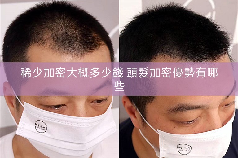 稀少加密大概多少錢 頭髮加密優勢有哪些