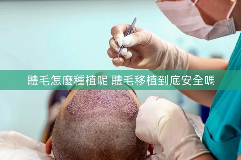 體毛怎麼種植呢 體毛移植到底安全嗎 體毛怎麼種植呢 體毛移植到底安全嗎
