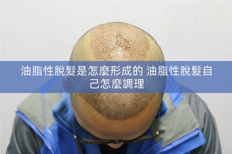 油脂性脫髮是怎麼形成的 油脂性脫髮自己怎麼調理